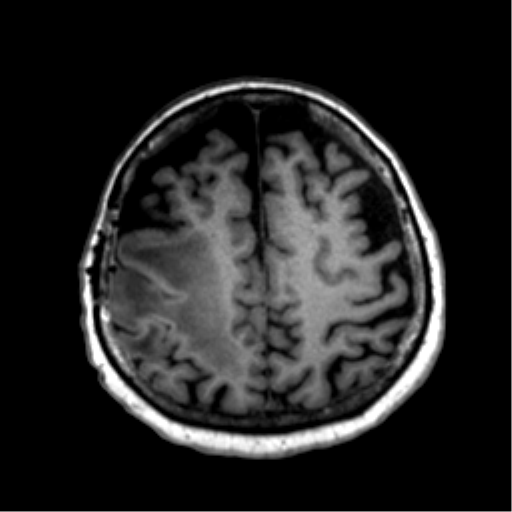 Anaplastic astrocytoma IDH wild-type (pseudoprogression) (Radiopaedia 42209-45277 Axial T1 99).png