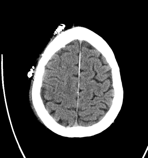 File:Anaplastic meningioma with recurrence (Radiopaedia 34452-35786 Axial non-contrast 26).png