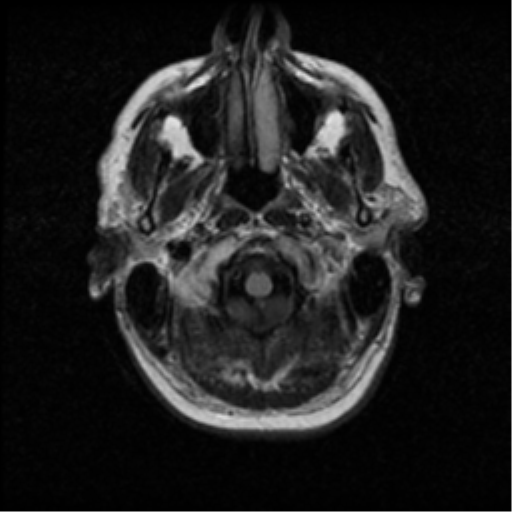 File:Anaplastic meningioma with recurrence (Radiopaedia 34452-35789 Axial FLAIR 2).png