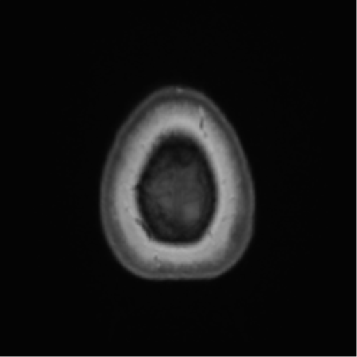 Anaplastic oligodendroglioma (Radiopaedia 83500-98599 Axial T1 73).png
