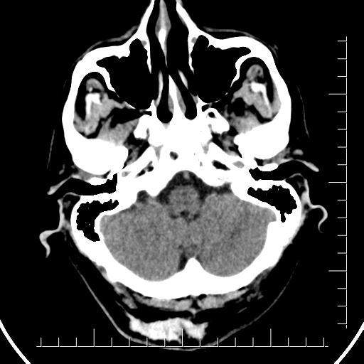 File:Aneurysm of posterior communicating artery (Radiopaedia 20188-20162 Axial non-contrast 8).jpg