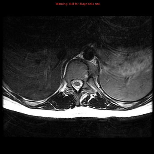 File:Aneurysmal bone cyst (Radiopaedia 9419-10103 Axial T2 14).jpg