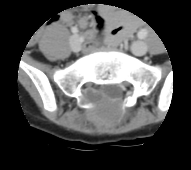 Aneurysmal bone cyst - sacrum (Radiopaedia 65190-74195 Axial non-contrast 18).jpg