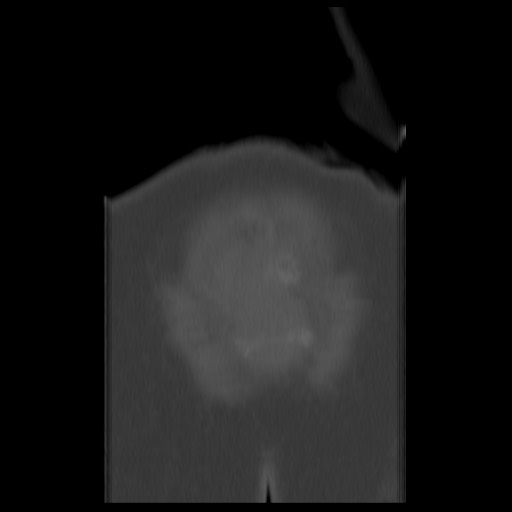 File:Aneurysmal bone cyst - sacrum (Radiopaedia 65190-74195 Coronal bone window 18).jpg