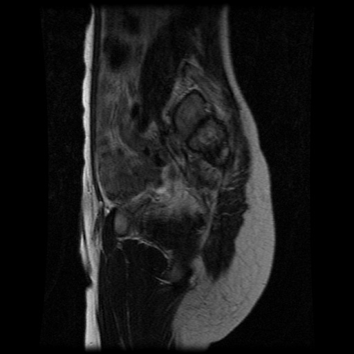 File:Aneurysmal bone cyst - sacrum (Radiopaedia 65190-74196 Sagittal T2 11).jpg
