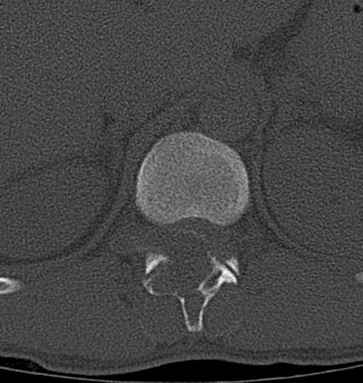 Aneurysmal bone cyst T11 (Radiopaedia 29294-29721 Axial bone window 47).jpg