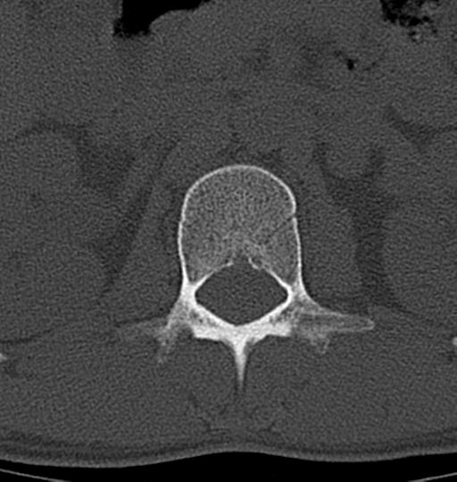 Aneurysmal bone cyst T11 (Radiopaedia 29294-29721 Axial bone window 65).jpg