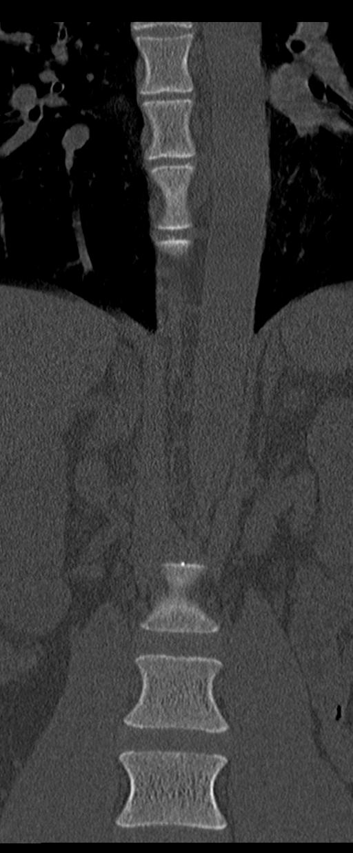 Aneurysmal bone cyst T11 (Radiopaedia 29294-29721 Coronal bone window 14).jpg