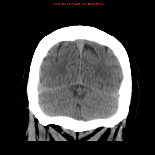 File:Aneurysmal subarachnoid hemorrhage (Radiopaedia 24740-24997 Coronal non-contrast 42).jpg