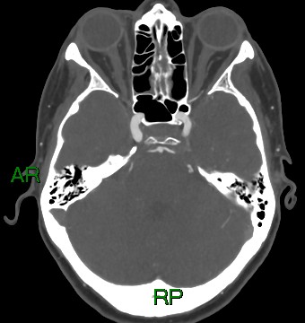 File:Aneurysmal subarachnoid hemorrhage with intra-axial extension (Radiopaedia 84371-99732 A 36).jpg