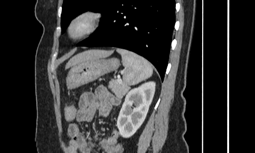 Annular pancreas (Radiopaedia 70359-80453 B 48).jpg