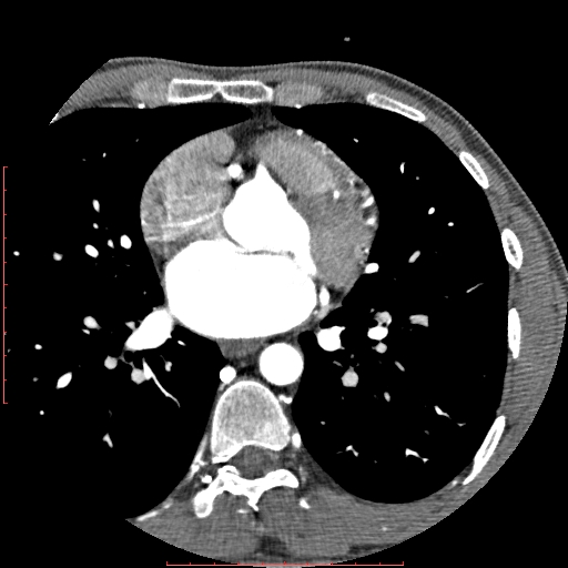 File:Anomalous left coronary artery from the pulmonary artery (ALCAPA) (Radiopaedia 70148-80181 A 147).jpg