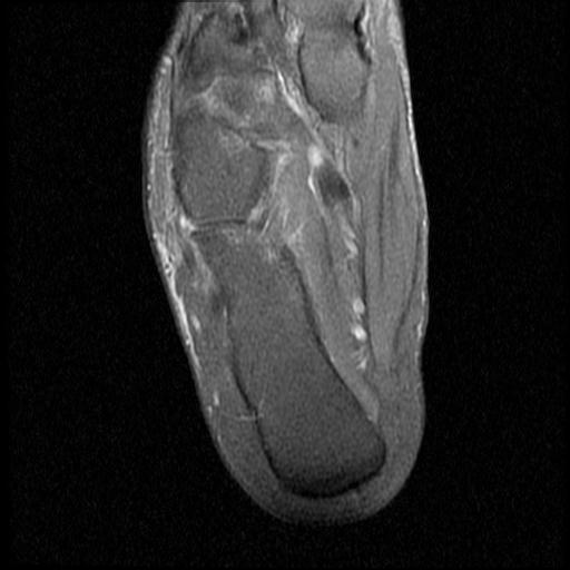 File:Anterior calcaneal process fracture (Radiopaedia 71377-81705 Axial PD fat sat 14).jpg