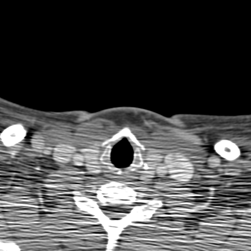 Anterior cerebral artery territory infarct (Radiopaedia 39327-41581 B 90).png
