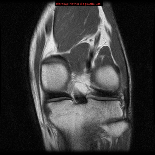 File:Anterior cruciate ligament injury - partial thickness tear (Radiopaedia 12176-12515 D 9).jpg