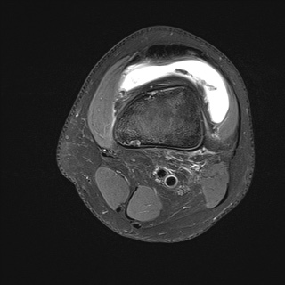 File:Anterior cruciate ligament tear - pediatric (Radiopaedia 62152-70260 Axial PD fat sat 4).jpg