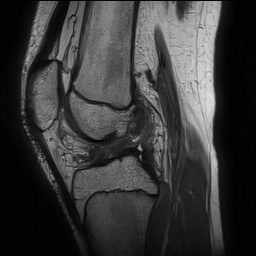 Anterior cruciate ligament tear - pediatric (Radiopaedia 62152-70260 Sagittal PD 93).jpg