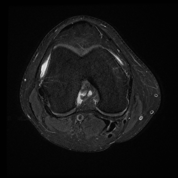 File:Anterior cruciate ligament tear with posteromedial corner injury, bucket-handle meniscal tear and chondral delamination (Radiopaedia 75501-86744 Axial PD fat sat 14).jpg