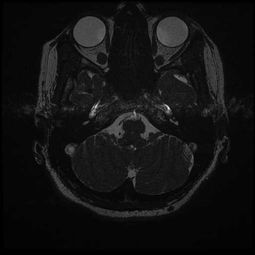 Anterior inferior cerebellar artery vascular loop - type II (Radiopaedia 70991-81209 Axial 3D FIESTA 56).jpg