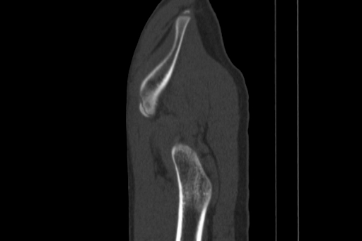 Anterior inferior iliac spine avulsion injury (Radiopaedia 88666-105376 Sagittal bone window 84).jpg