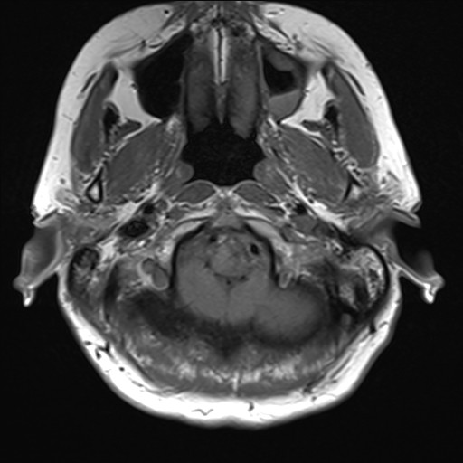 File:Anterior temporal encephalocele (Radiopaedia 82624-96808 Axial T1 2).jpg