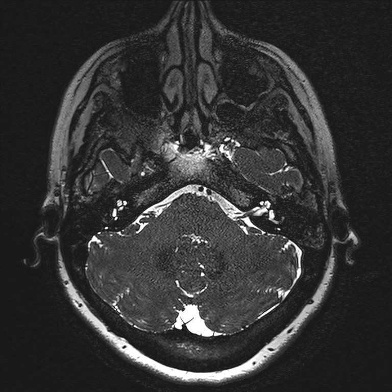 Anterior temporal encephalocele (Radiopaedia 82624-96808 Axial T2 high res 8).jpg