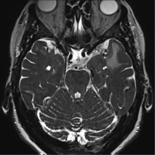 File:Anterior temporal pole cysts (Radiopaedia 46629-51102 Axial 36).png
