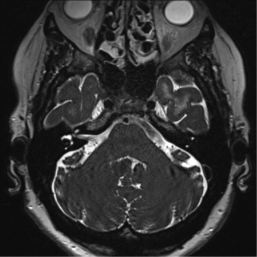 Anterior temporal pole cysts (Radiopaedia 46629-51102 Axial 5).png