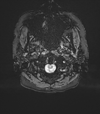 Anterior temporal pole cysts (Radiopaedia 46629-51102 Axial SWI 1).png