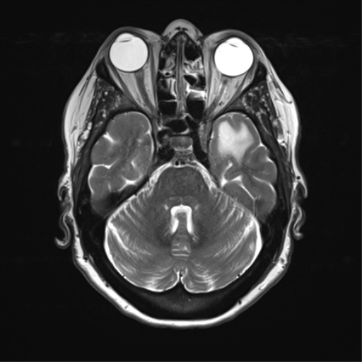 File:Anterior temporal pole cysts (Radiopaedia 46629-51102 C 12).png