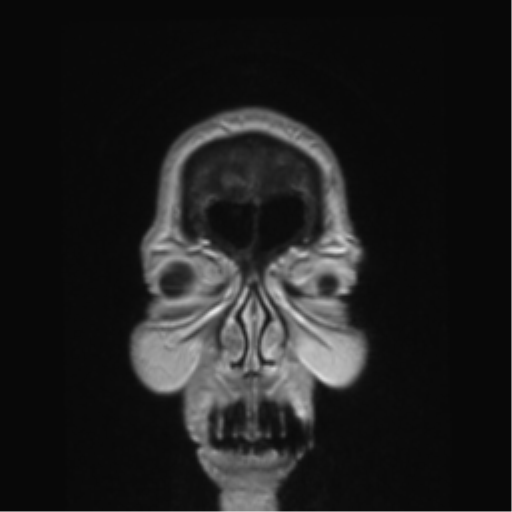 Anterior temporal pole cysts (Radiopaedia 46629-51102 Coronal T1 C+ 169).png