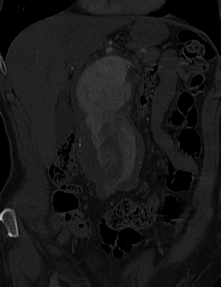 Anterior vertebral scalloping (abdominal aortic aneurysm) (Radiopaedia 66744-76067 Coronal bone window 2).jpg