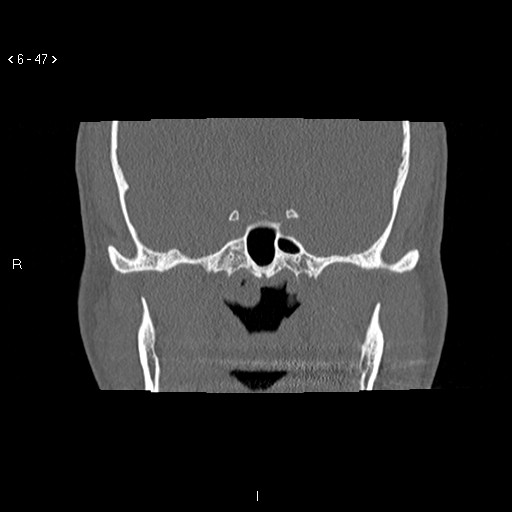 File:Antrochoanal Polyp (Radiopaedia 70510-80631 Coronal bone window 36).jpg
