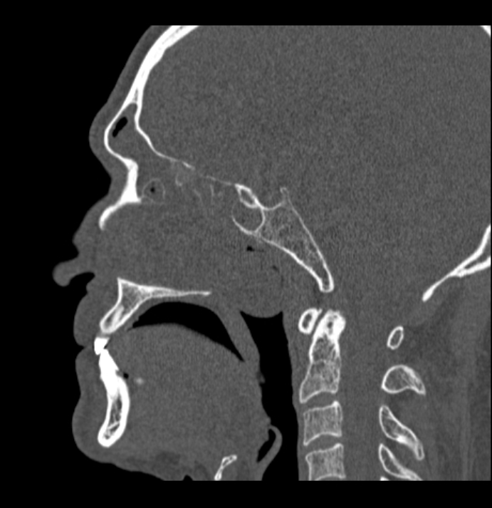 Antrochoanal polyp (Radiopaedia 79011-92169 Sagittal bone window 24).jpg