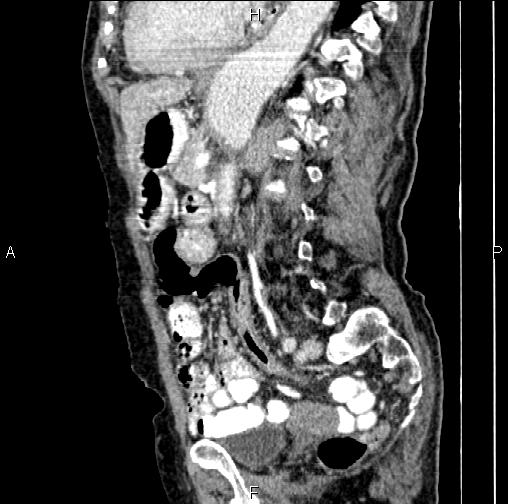 Aortic aneurysm and Lemmel syndrome (Radiopaedia 86499-102554 D 54).jpg