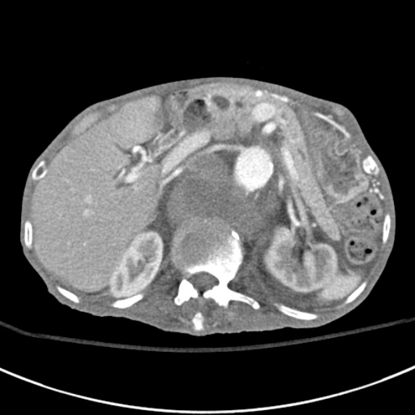 File:Aortic aneurysm with spinal destruction (Radiopaedia 42301-45410 A 29).jpg