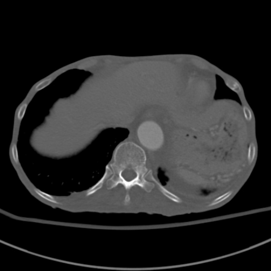 Aortic aneurysm with spinal destruction (Radiopaedia 42301-45410 Axial bone window 12).jpg