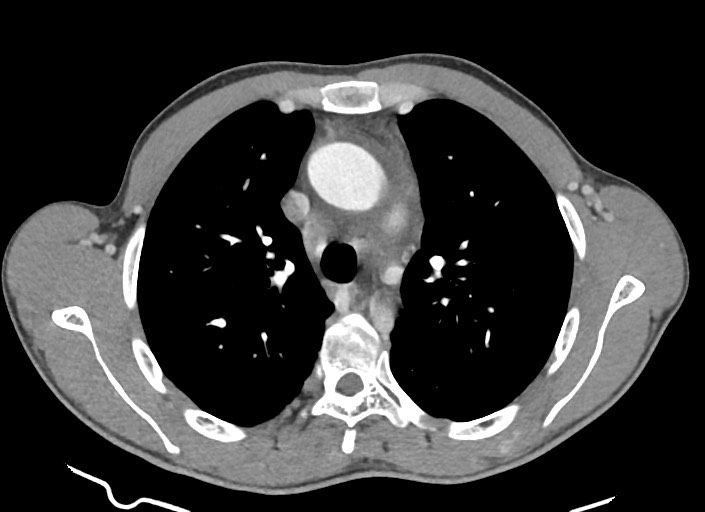 File:Aortic coarctation with aneurysm (Radiopaedia 74818-85828 A 137).jpg