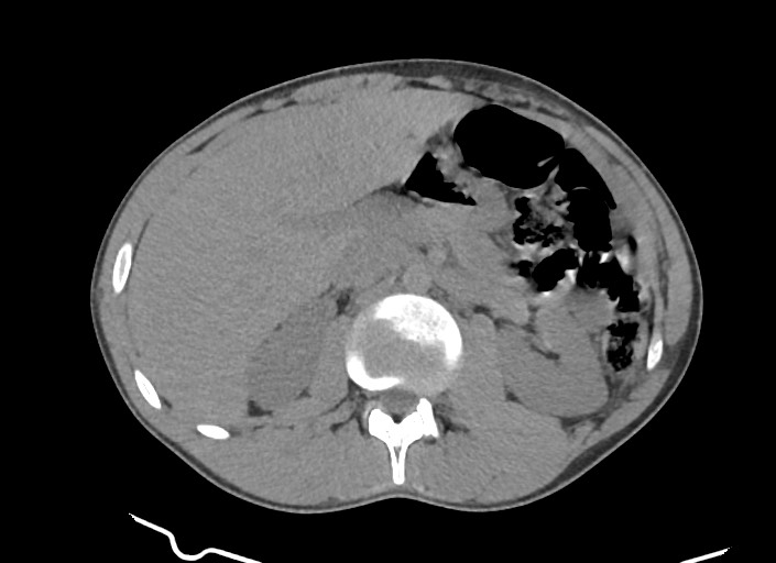 File:Aortic coarctation with aneurysm (Radiopaedia 74818-85828 A 14).jpg