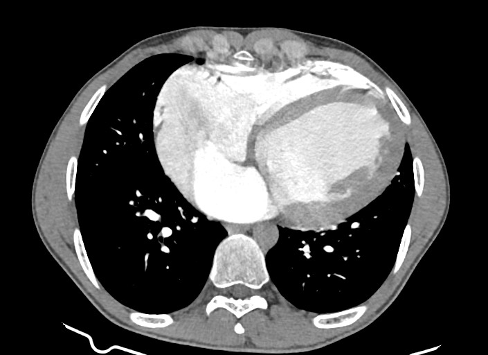File:Aortic coarctation with aneurysm (Radiopaedia 74818-85828 A 80).jpg