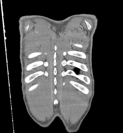 File:Aortic coarctation with aneurysm (Radiopaedia 74818-85828 C 112).jpg