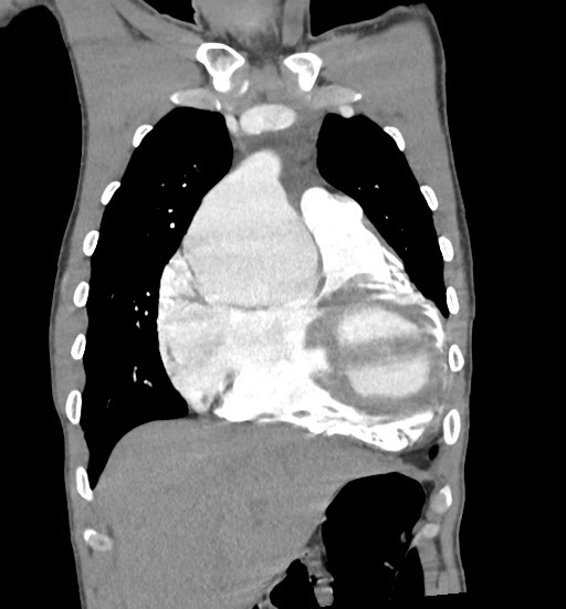 File:Aortic coarctation with aneurysm (Radiopaedia 74818-85828 C 31).jpg
