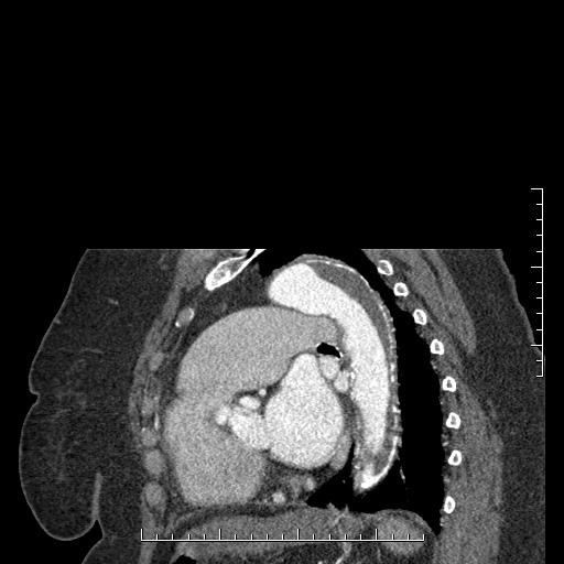 File:Aortic dissection- Stanford A (Radiopaedia 35729-37268 D 10).jpg