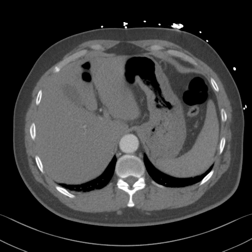 File:Aortic dissection (Radiopaedia 50763-56234 A 69).png