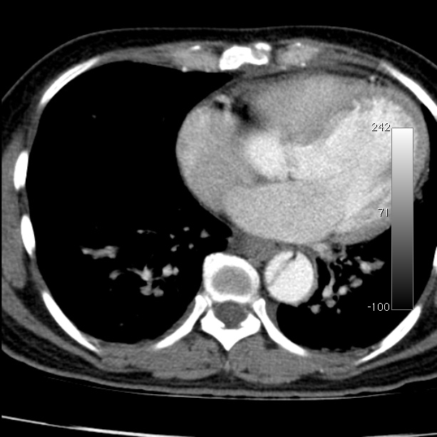 Aortic dissection - Stanford type A (Radiopaedia 29247-29659 A 52).jpg