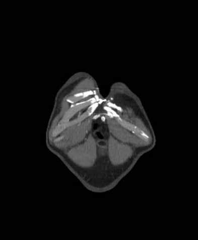 Aortic dissection - Stanford type B (Radiopaedia 73648-84437 B 1).jpg