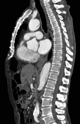 File:Aortic dissection - Stanford type B (Radiopaedia 73648-84437 C 76).jpg