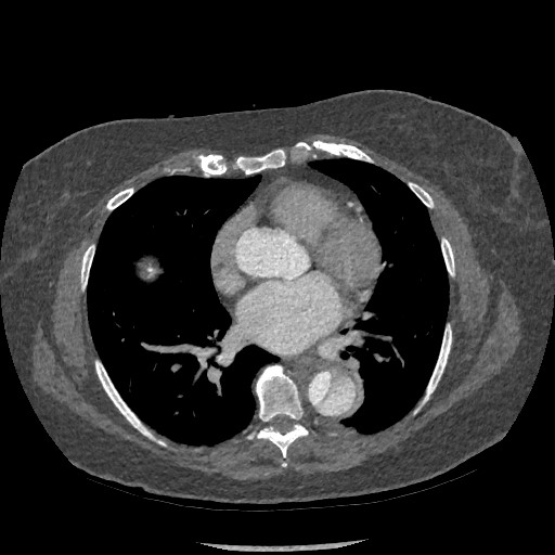 Aortic dissection - Stanford type B (Radiopaedia 88281-104910 A 50).jpg