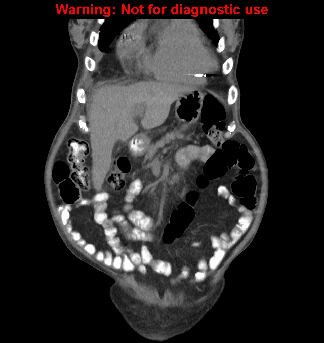 Aortic graft infection (Radiopaedia 44979-48907 non-contrast 13).jpg