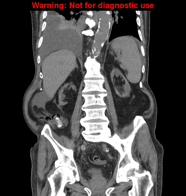 Aortic graft infection (Radiopaedia 44979-48907 non-contrast 33).jpg